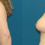 Breast Augmentation & Lift #19 - Before and After