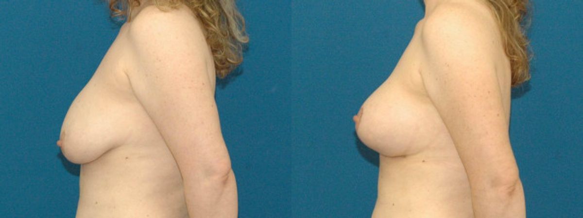 Breast Augmentation & Lift #19 - Before and After