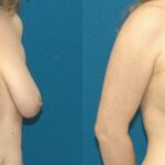 Breast Augmentation & Lift #19 - Before and After