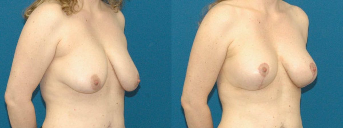 Breast Augmentation & Lift #19 - Before and After
