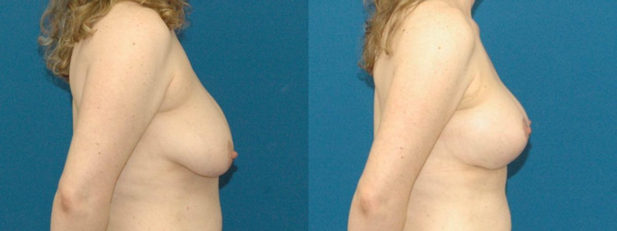 Breast Augmentation & Lift #19 - Before and After