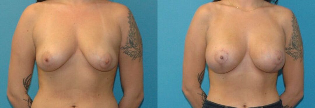 Breast Augmentation & Lift #20