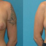 Breast Augmentation & Lift #20 - Before and After