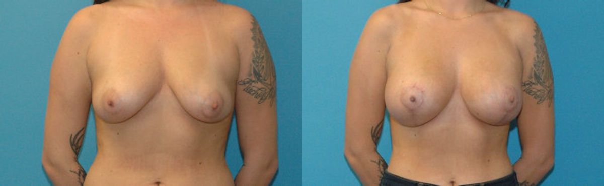 Breast Augmentation & Lift #20 - Before and After