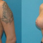 Breast Augmentation & Lift #20 - Before and After