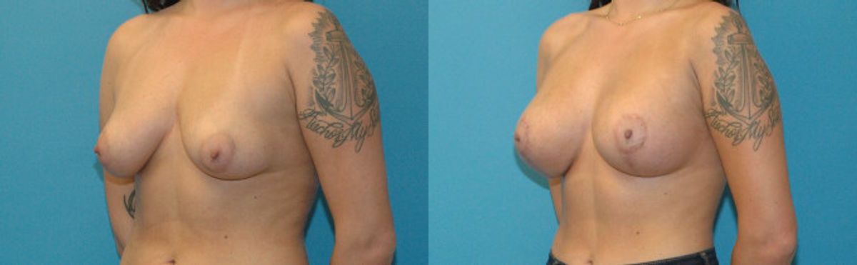 Breast Augmentation & Lift #20 - Before and After