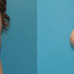 Breast Augmentation & Lift #20 - Before and After