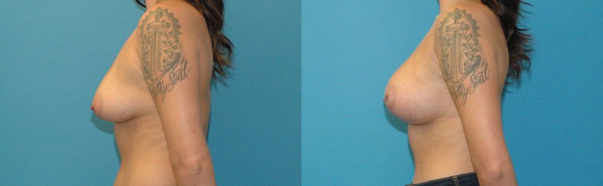 Breast Augmentation & Lift #20 - Before and After