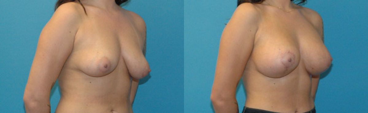 Breast Augmentation & Lift #20 - Before and After