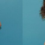 Breast Augmentation & Lift #20 - Before and After