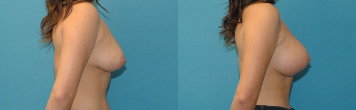 Breast Augmentation & Lift #20 - Before and After