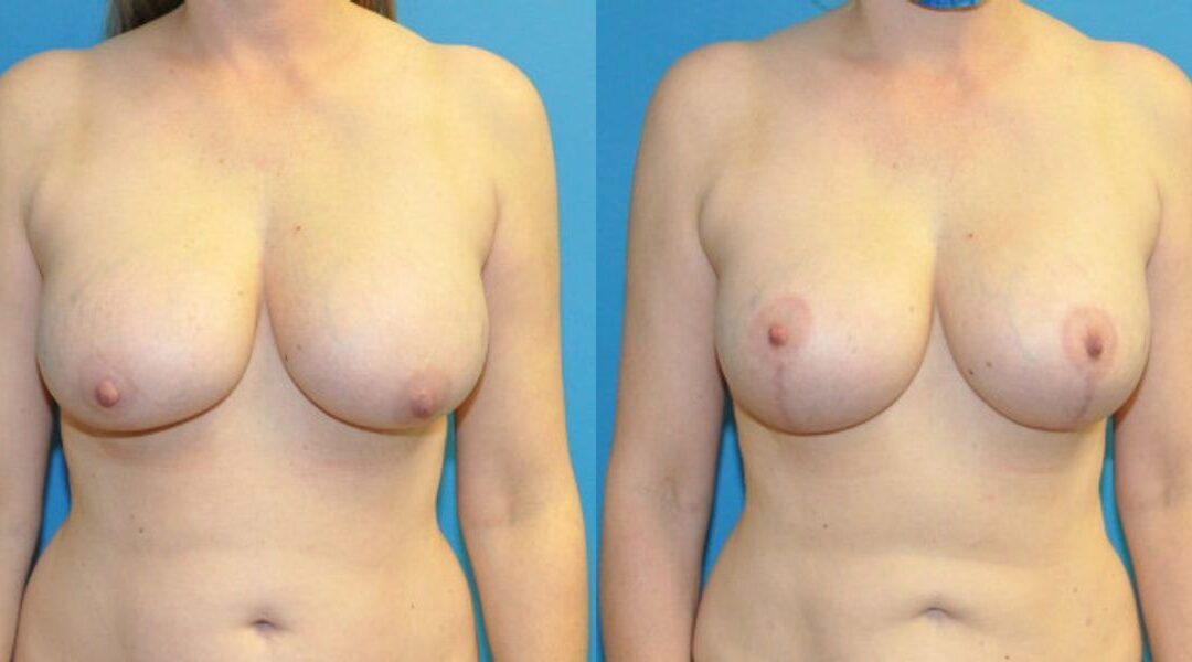 Breast Augmentation & Lift #21