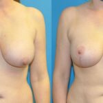 Breast Augmentation & Lift #21 - Before and After