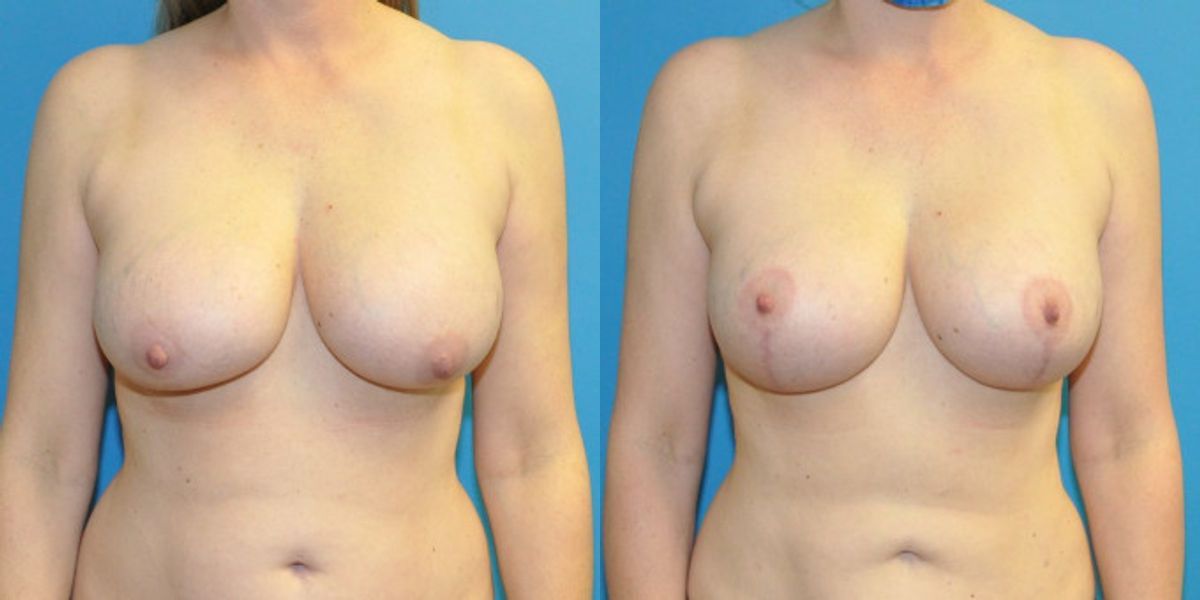 Breast Augmentation & Lift #21 - Before and After