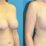 Breast Augmentation & Lift #21 - Before and After