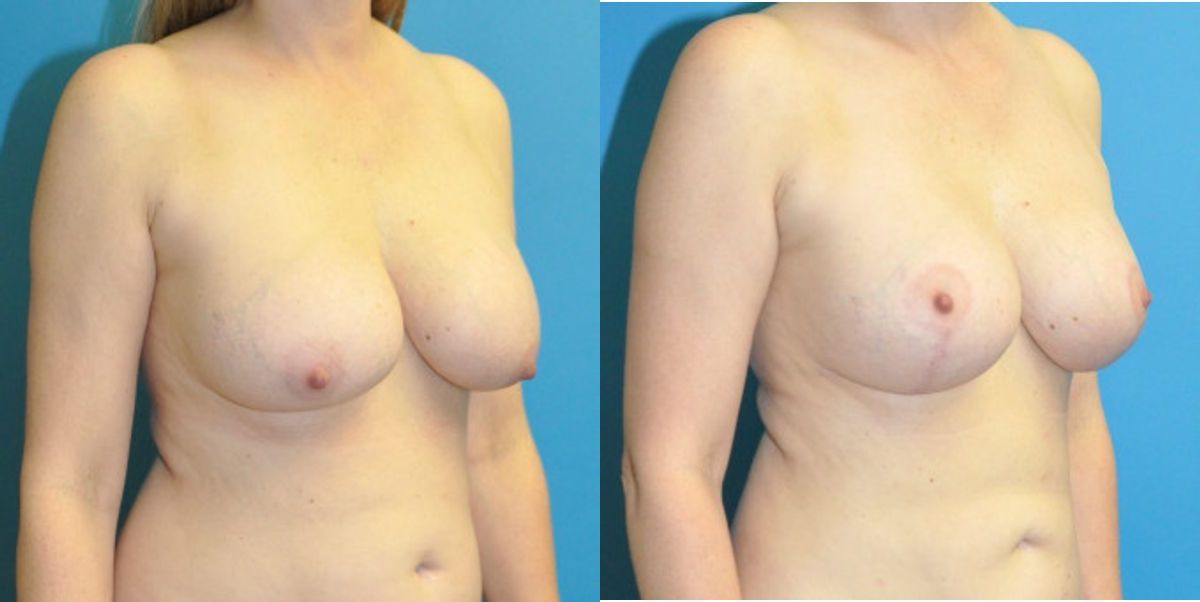 Breast Augmentation & Lift #21 - Before and After