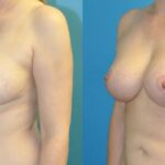 Breast Augmentation & Lift #21 - Before and After