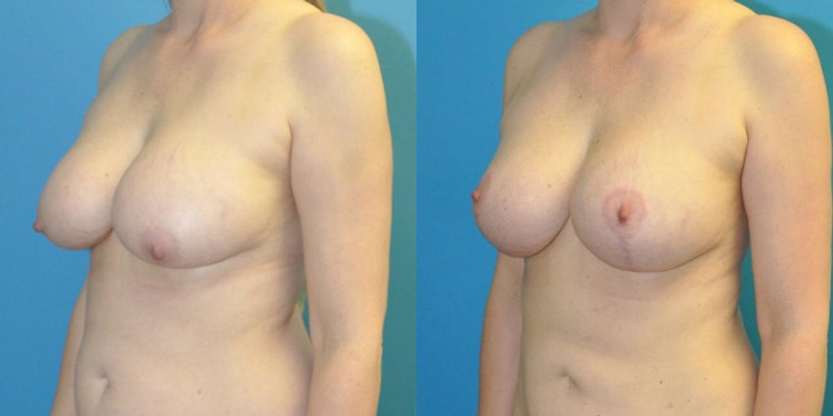 Breast Augmentation & Lift #21 - Before and After