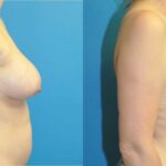 Breast Augmentation & Lift #21 - Before and After