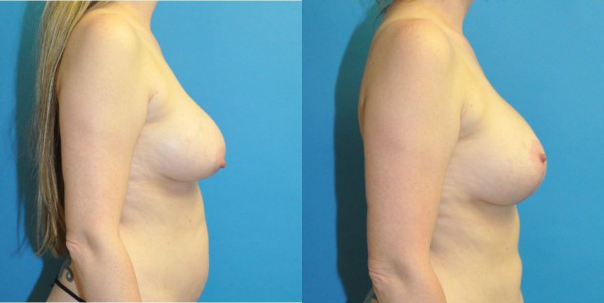 Breast Augmentation & Lift #21 - Before and After
