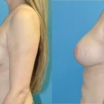 Breast Augmentation & Lift #21 - Before and After