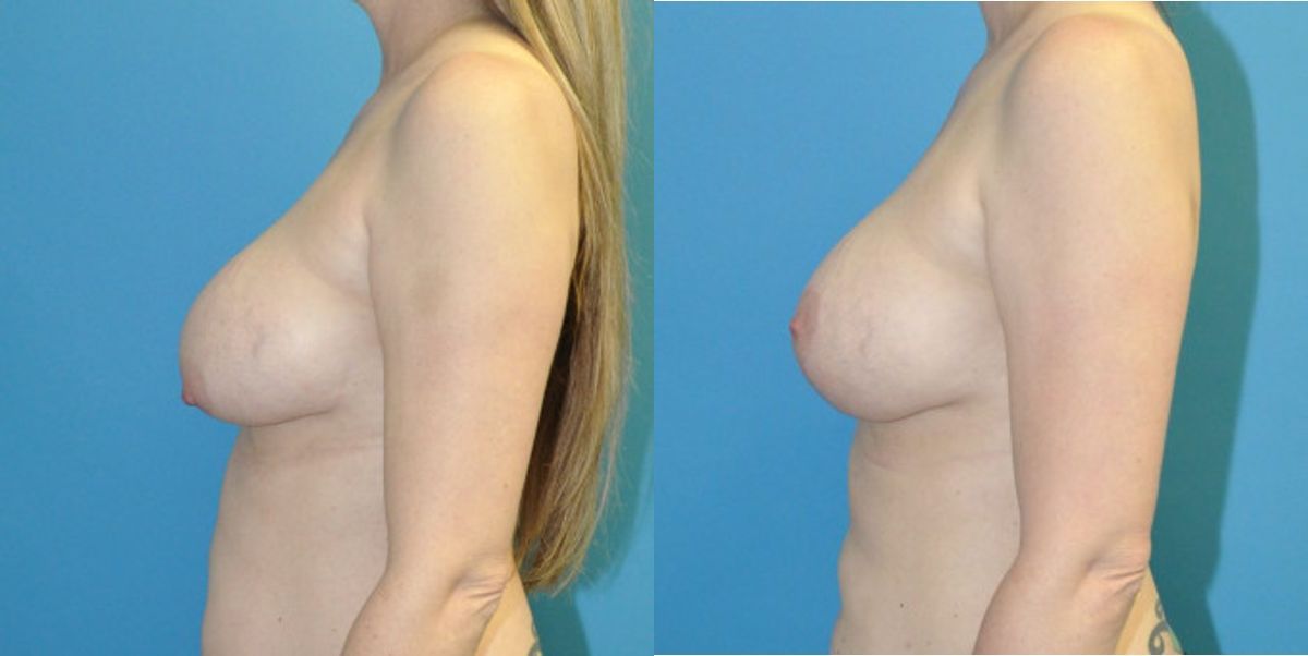 Breast Augmentation & Lift #21 - Before and After