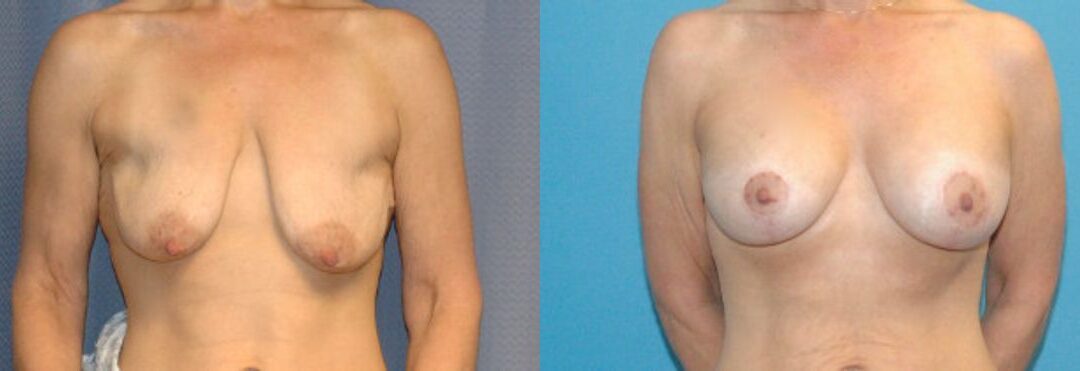 Breast Augmentation & Lift #22