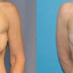 Breast Augmentation & Lift #22 - Before and After