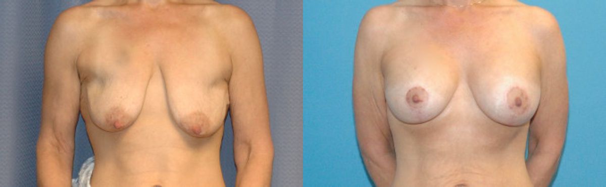 Breast Augmentation & Lift #22 - Before and After