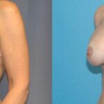 Breast Augmentation & Lift #22 - Before and After