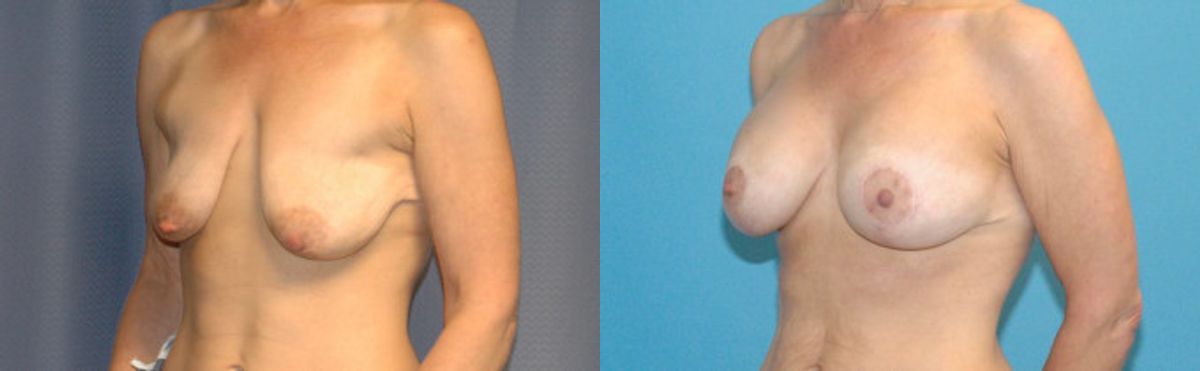 Breast Augmentation & Lift #22 - Before and After