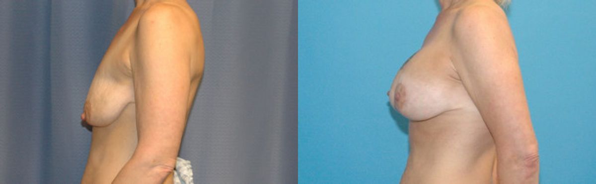 Breast Augmentation & Lift #22 - Before and After