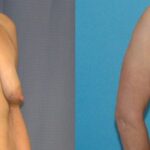 Breast Augmentation & Lift #22 - Before and After