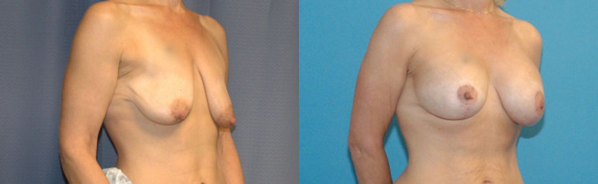 Breast Augmentation & Lift #22 - Before and After