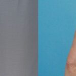 Breast Augmentation & Lift #22 - Before and After