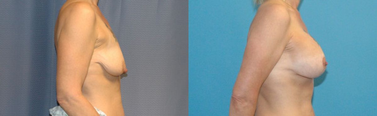 Breast Augmentation & Lift #22 - Before and After