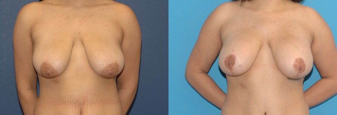 Breast Augmentation & Lift #23
