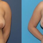 Breast Augmentation & Lift #23 - Before and After