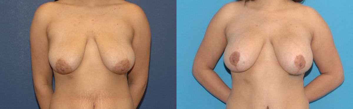 Breast Augmentation & Lift #23 - Before and After