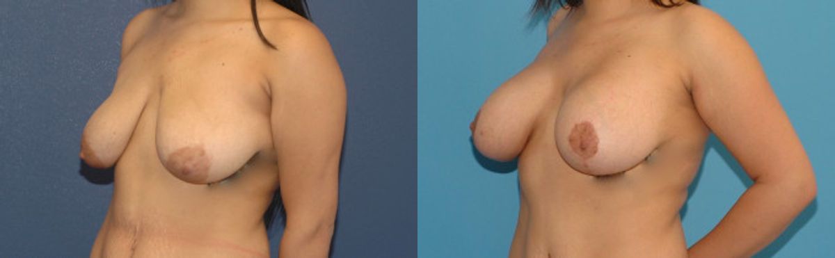 Breast Augmentation & Lift #23 - Before and After
