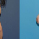 Breast Augmentation & Lift #23 - Before and After