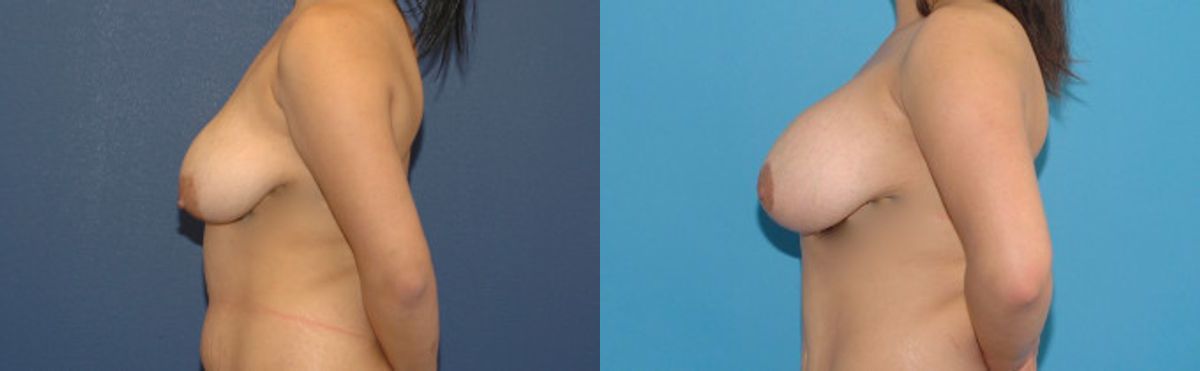 Breast Augmentation & Lift #23 - Before and After