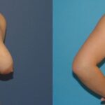 Breast Augmentation & Lift #23 - Before and After