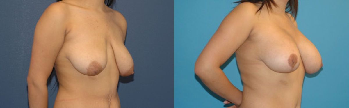 Breast Augmentation & Lift #23 - Before and After