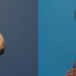 Breast Augmentation & Lift #23 - Before and After