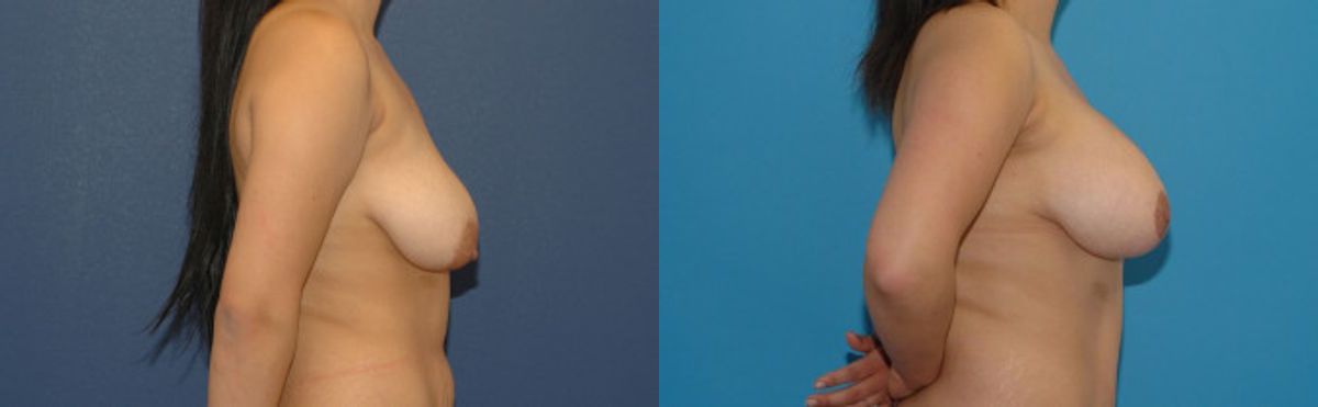 Breast Augmentation & Lift #23 - Before and After