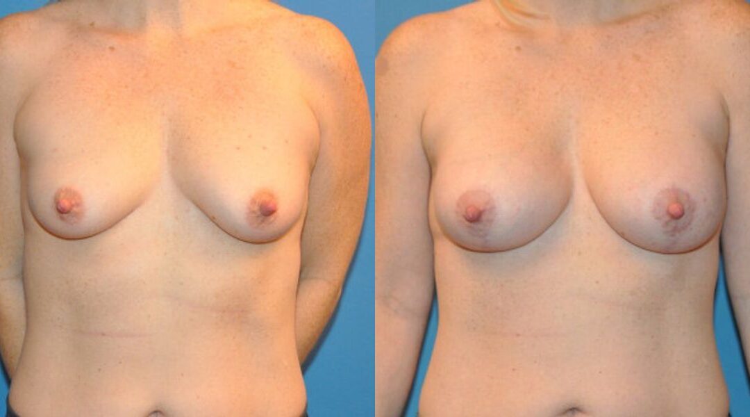 Breast Augmentation & Lift #24