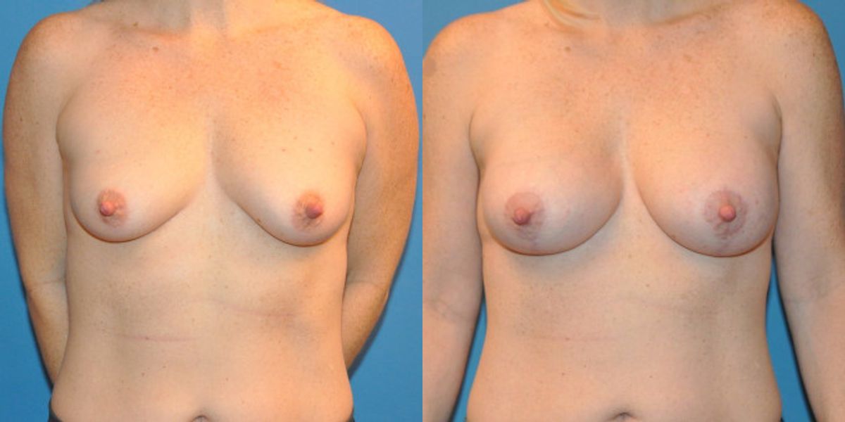 Breast Augmentation & Lift #24 - Before and After