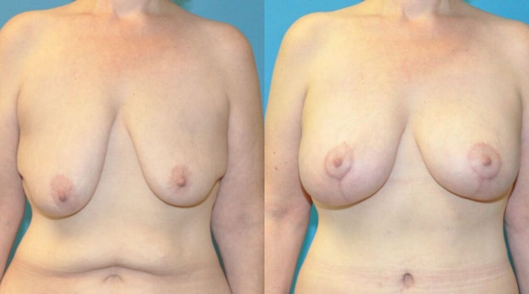 Breast Augmentation & Lift #25