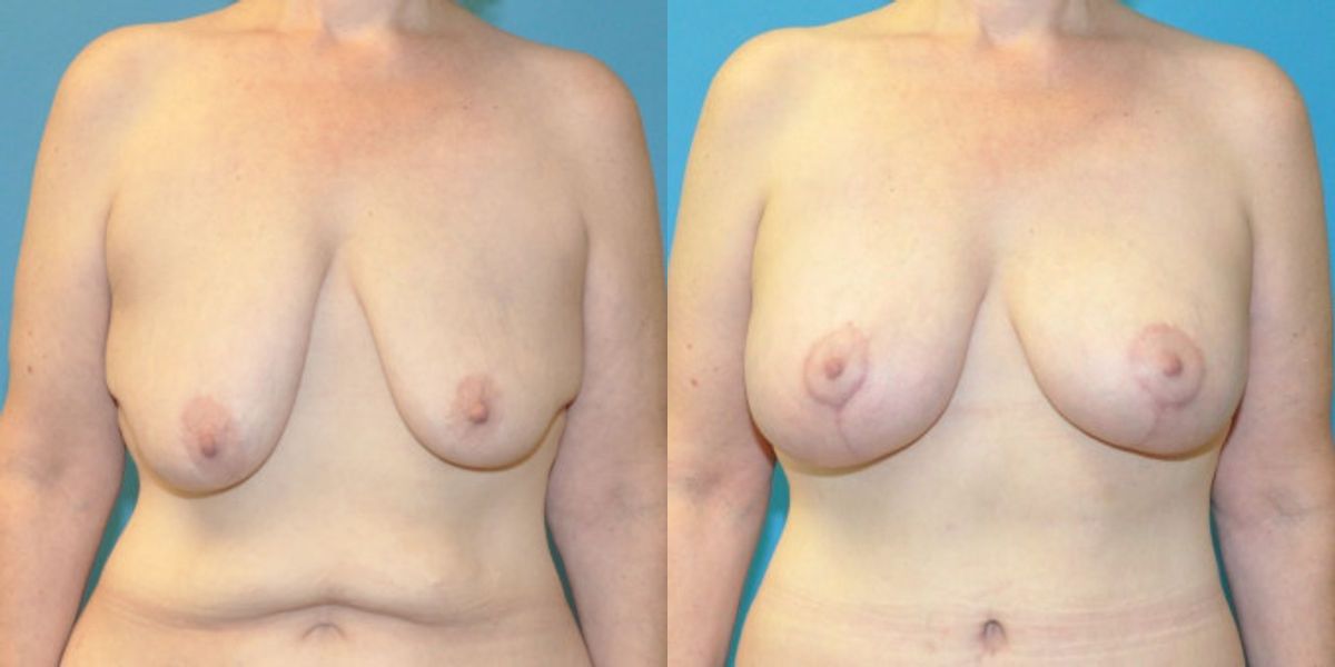 Breast Augmentation & Lift #25 - Before and After